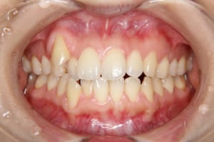 右上犬歯の低位唇側転位、前歯部叢生